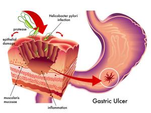 gatric-ulcer